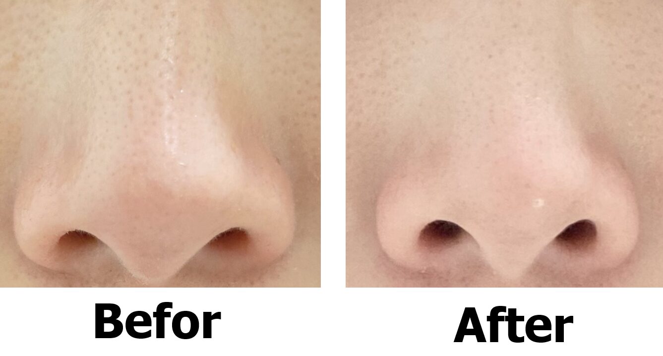 NIPLUX QNoseを1週間使用した鼻と2週間使用した鼻を比較した写真